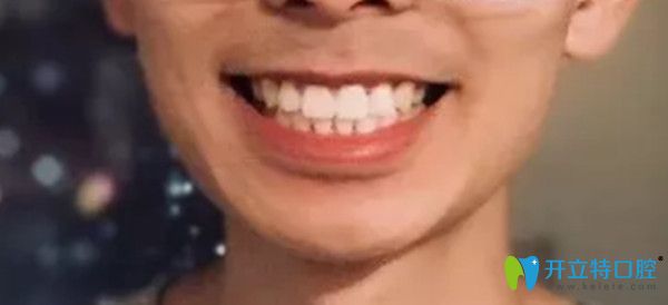 齙牙矯正前后對比圖
