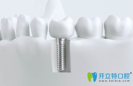 想問下:韓國的種植牙品牌美格真和登騰以及奧齒泰哪個(gè)好呢?