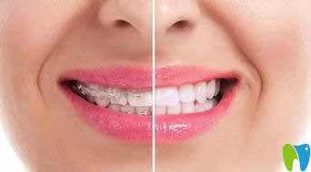 李永信醫(yī)生在矯正牙齒同時(shí)注重塑造美麗笑線