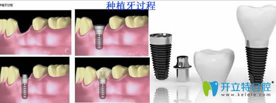 韓國各品牌的種植牙過程