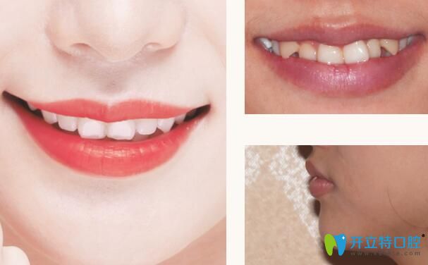 深圳格倫菲爾口腔矯正牙齒怎么樣呢？來看看真人正畸案例