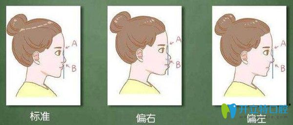 自測輕微齙牙的七種方式