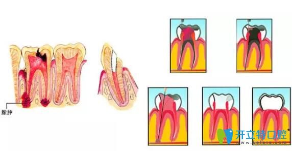 死髓牙怎么治療