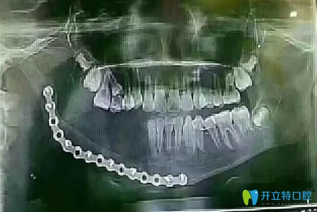 乳牙壞了會(huì)影響恒牙嗎?小姑娘因乳牙齲壞花16萬切除下頜骨!