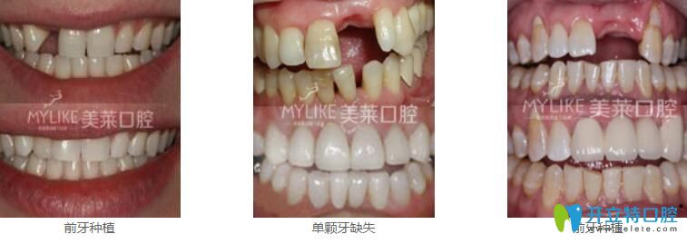 深圳種植牙哪家好？來(lái)看美萊口腔真人種植牙案例效果對(duì)比圖