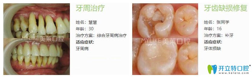 美萊口腔牙周病治療案例+牙齒缺損修復(fù)案例