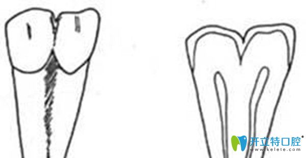 什么是融合牙 什么是融合牙