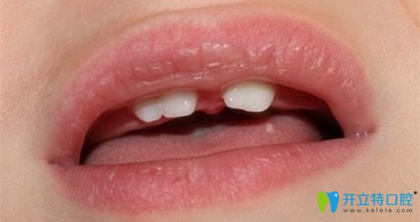 導(dǎo)致融合牙的因素有哪些 導(dǎo)致融合牙的因素有哪些