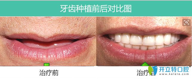 長春牙博士口腔全口allon4種植牙案例