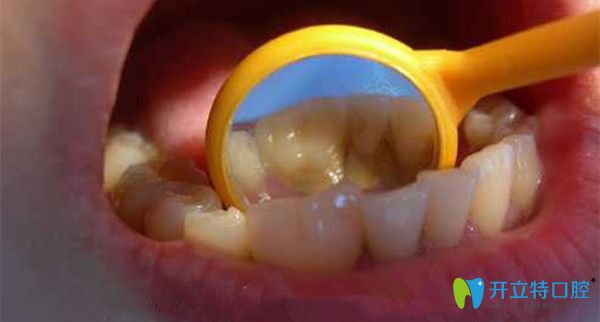 福州艾尚美口腔解析——兒童融合牙換牙后會好嗎？