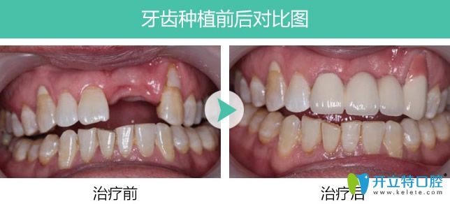 長春超龍牙博士多顆牙缺失種植案例對比圖