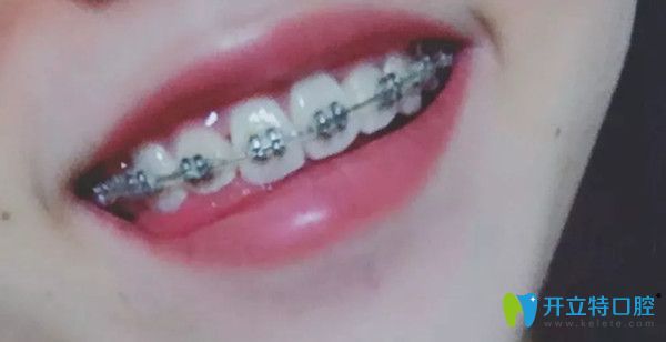 口腔正畸半年后的變化圖