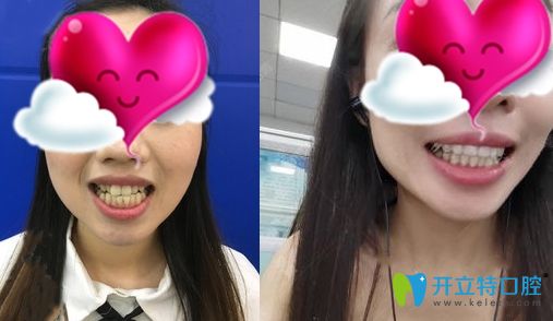 廣州壹加壹口腔的牙齒矯正效果對比圖
