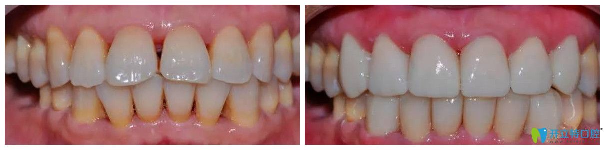 北極星口腔瓷貼面修復(fù)黃牙案例 北極星口腔瓷貼面修復(fù)黃牙案例