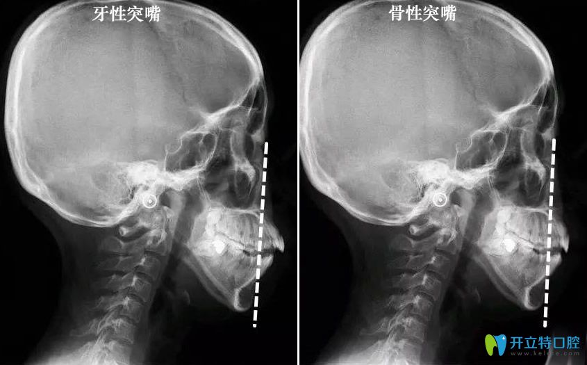 骨性突嘴和牙性凸嘴判斷對(duì)比圖