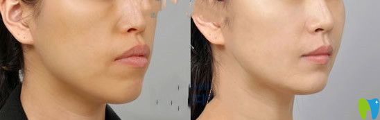 牙性突嘴做完牙齒矯正后的對(duì)比照