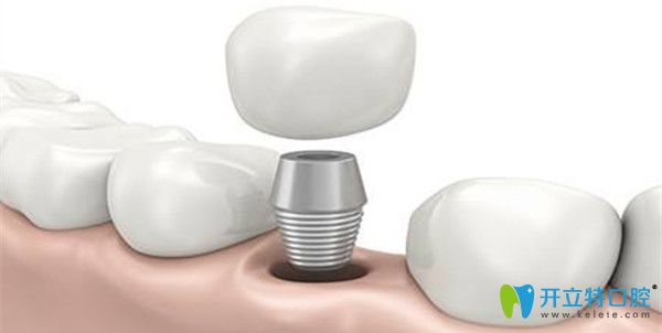 牙齒缺失修復(fù)選擇種植牙 牙齒缺失修復(fù)選擇種植牙