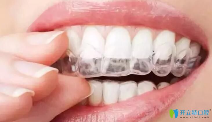 正畸咬膠使隱形牙套更貼合，更隱形