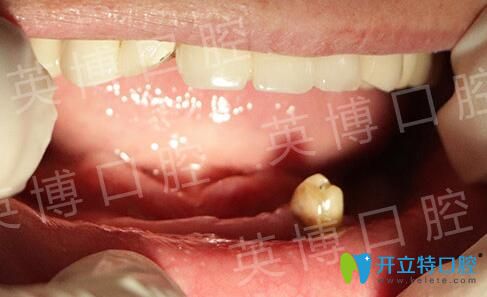 沒(méi)有在英博口腔做All-on-4即刻種植牙前