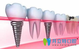 周宇醫(yī)生擅長各類種植牙技術(shù)