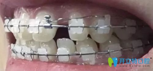 北京康貝佳口腔戴陶瓷托槽牙套側(cè)面照