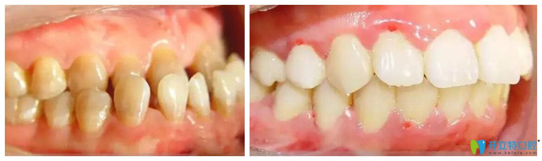 正畸案例來看看歡樂仁愛口腔矯正好不 正畸案例來看看歡樂仁愛口腔矯正好不