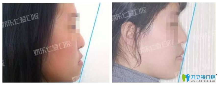 歡樂仁愛口腔骨性反合的掩飾性治療案例 歡樂仁愛口腔骨性反合的掩飾性治療案例