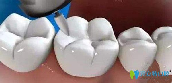 洗牙后要進(jìn)行牙齒拋光處理