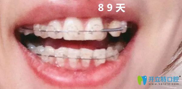 正畸第三個月變化圖