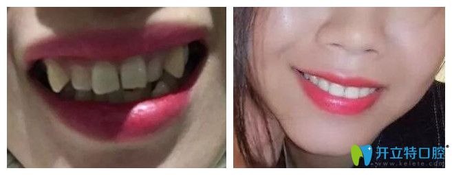 廣州廣大口腔隱形牙齒矯正案例