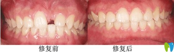 鄭州德正口腔前牙美學種植前后效果對比圖