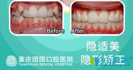 隱適美隱形矯正虎牙前后效果對(duì)比照片