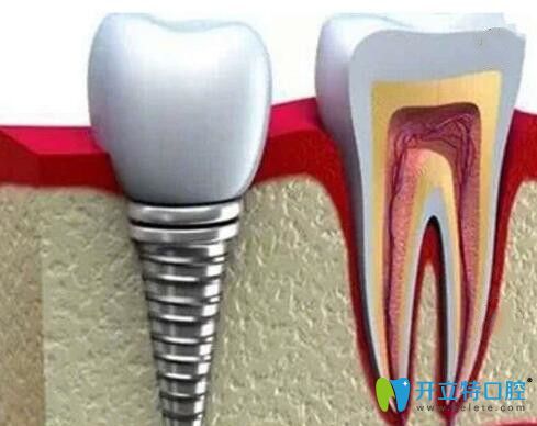 我在廣州光大口腔做種植牙