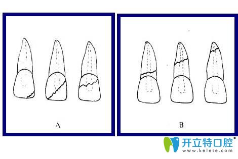 牙齒撞斷了怎么辦