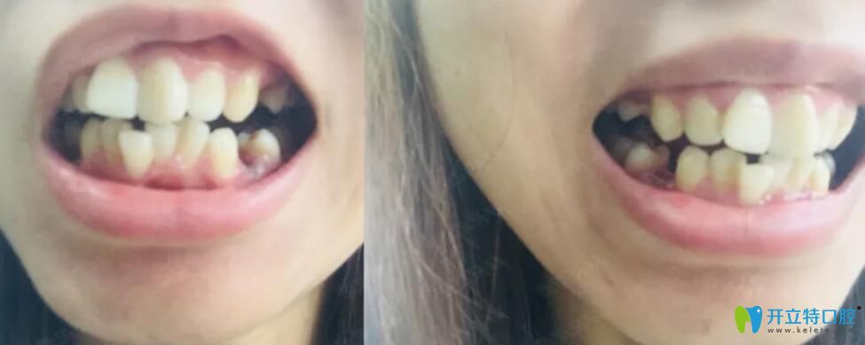 成都圣貝口腔牙齒矯正前