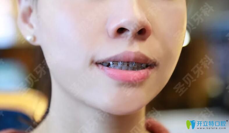 圣貝口腔齙牙矯正中效果圖