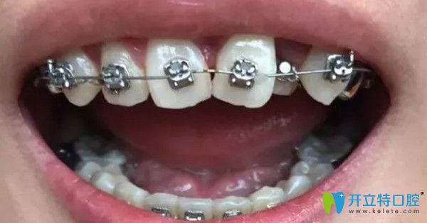 戴上上牙套的第三個(gè)月