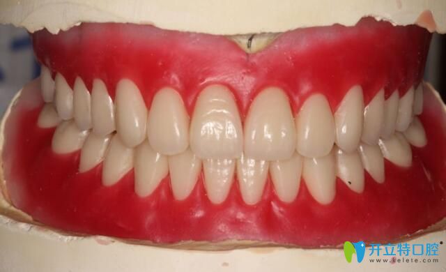全口吸附性義齒圖