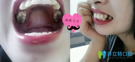 在深圳潤澤瑞尼絲口腔剛拔完牙的照片