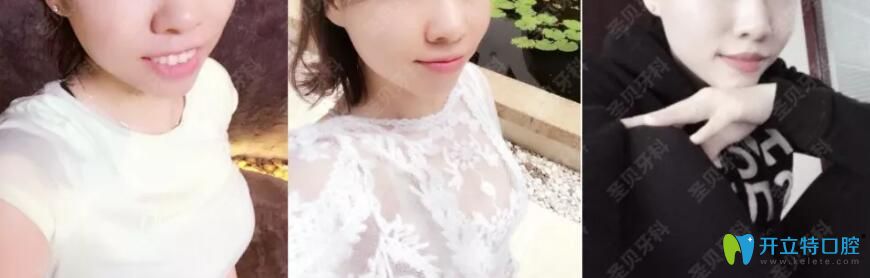 凸嘴齙牙在成都圣貝口腔矯正前