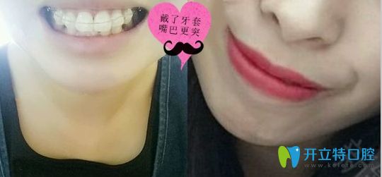 深圳潤澤瑞尼絲口腔戴了陶瓷托槽牙套矯正