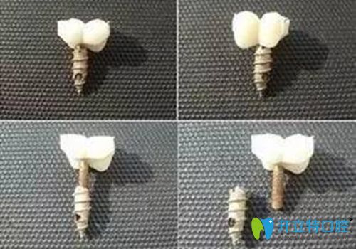 種植牙維護不好會導致使用時間減短