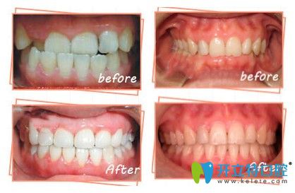 中諾口腔牙齒矯正案例圖