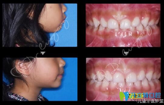 羅罡博士?jī)和罡埠铣C正前后效果對(duì)比圖