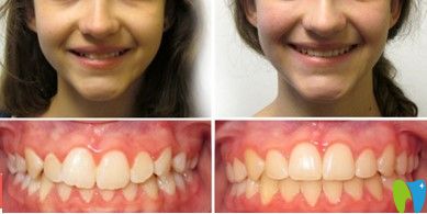 好佰年口腔牙齒深覆頜矯正前后對比圖