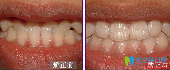 廣大口腔地包天隱適美隱形矯正