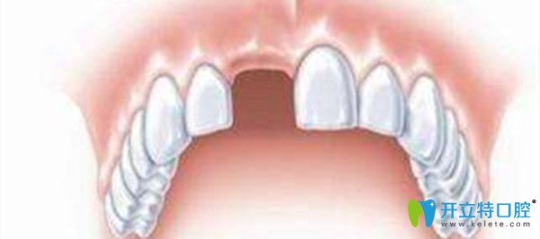 牙齒缺失也可以矯正