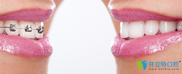 避免矯正中常見的誤區(qū)