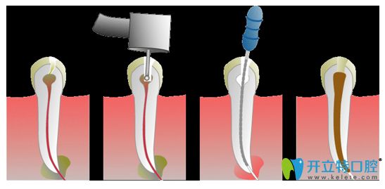 重慶維樂口腔唐文崢醫(yī)生介紹顯微根管與傳統(tǒng)根管治療的區(qū)別