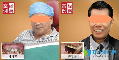 廣州廣大口腔半口牙種植案例效果圖